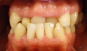 1- Foto inicial donde observamos mordida invertida anterior con importante apiñamiento y desviacion linea media dentaria