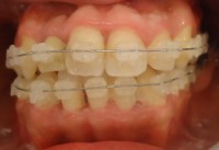 10-Vista frontal alineacion inf