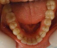 10 – contencion fija max inf de 3 a 3