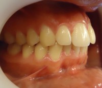 10 – Vista lateral donde vemos la correccion de la inclinacion de la pieza 21