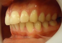 11 – Vista lateral izq  comienza la correccion de la guia anterior y overjet