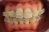 13- Vista frontal del tratamiento