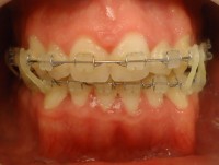 13- Vista frontal en oclusion luego de la cirugia reubicando max inferior