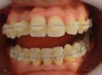 14- Alineacion max inferior