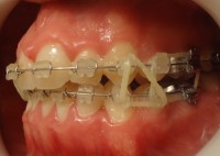 14 -Vista lateral izq utilizacion de gomas intermaxilares dobles