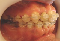 15- Vista lateral de la evolucion del tratamiento,
