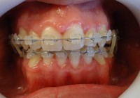 16 -Luego de la cirugia ortognatica, utilizacion de gomas para asentar la oclusion