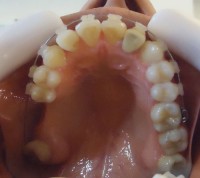 17- Vista oclusal max sup alineado