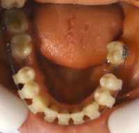 18-Vista oclusal max inf alineado