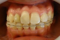 19-Retiro aparatologia sup