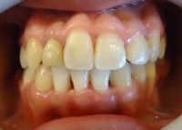 20- Retiro aparatologia