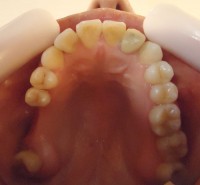 21- Vista oclusal sup sin aparatologia