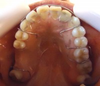 22- Vista oclusal sup Placa Hawley de contencion manteniendo espacio en piezas 1.6 y 1.7