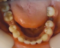 23- Vista oclusal max inf contencion fija de 3 a 3