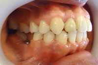 24- Vista final lateral dercho con colocacion de implante pieza 4.6