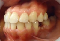 24-Vista final lateral izq con colocacion de implante pieza 3.6