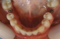 25- Vista oclusal inf con tapones cicatrizales en implantes 3.6 y 4.6