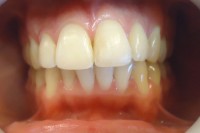 26  -Final tto max sup estetica vestibular pieza 21