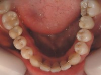 27-Finalizacion de coronas en piezas 3.6 y 4.6