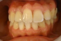 28-Foto final del tratamiento en oclusion con corona definitiva en 1.2