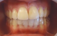 29 – Vista de frente en oclusion