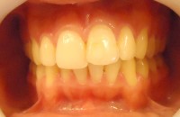 30 – Antes del tto max sup