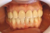 4 – Foto final de rehabilitacion con protesis fija reemplazando piezas de sector supoerior de PM a PM