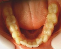 4 –  Foto inicial arcada inf, apiñamiento y falta de espacio para laterales