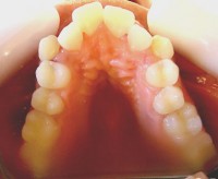 4-Foto inicial vista oclusal max sup. Se observa importante apiñamiento para 13 y 23