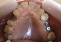 4 - Vista oclusal max sup con implantes colocados reemplazando piezas 1.4, 2.5,y 2.6