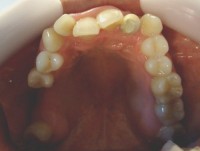 4- Vista oclusal max sup. Apiñamiento con falta de espacio para caninos