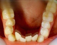 5-Foto inicial vista oclusal max inf. Apiñamiento anterior