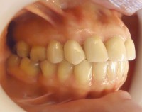 5 –  Vista lateral derecho con correcion de mordida cruzada