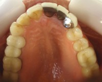 5 – Vista oclusal del max sup