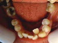 5-Vista oclusal max inf. Apiñamiento importante con falta de espacio para pieza 3.2