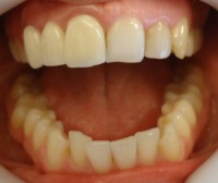 6 – Foto inicial apertura