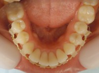 8 – Vista oclusal max inf ya alineado