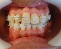 9-Armado max inferior luego del descruce de la mordida invertida anterior