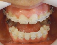 9- Se observan ambos max alineados. Max inf con exodoncias de piezas 3.5 y 4.5