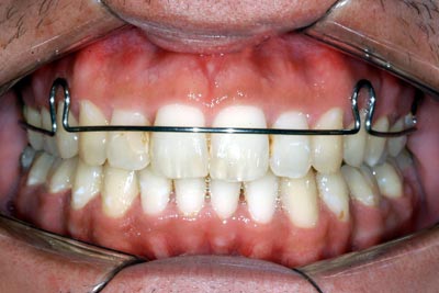 Móvil Instrumento Descriptivo Contención y Retiro de brackets, tipos de ortodoncia invisible, brackets de  zafiro, metalicos, porcelana, sistema damon, tratamientos estéticos  dentales, ortodoncista buenos aires | Dentistas Estetica dental -  Ortodoncia Salud