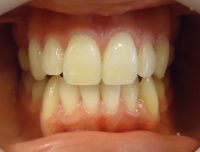 10-Vista de alineado