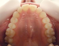 10- Vista del alineamiento