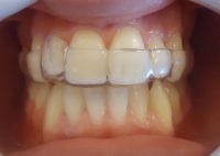 11- Secuencia de alineadores