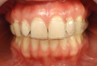 11-Secuencia de alineadores