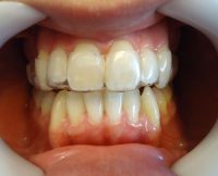 13- Secuencia de alineadores