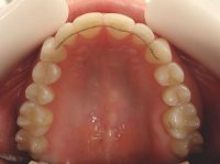 17- Vista oclusal con contención fija