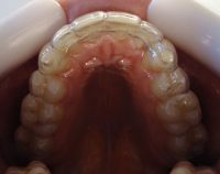 17-Vista oclusal de ambas contenciones