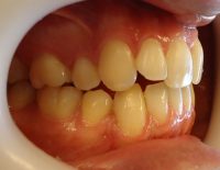 2-Lateral derecho observando relacion canina y clase molar