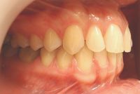 3-Vista lateral dercho