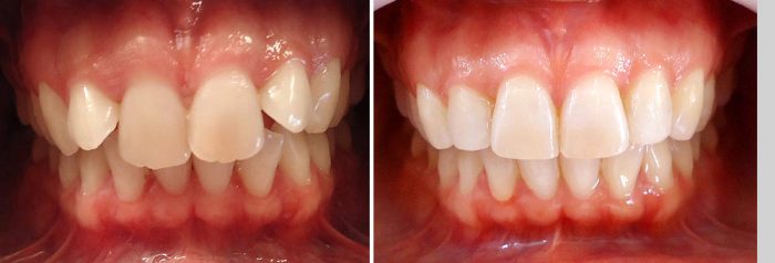 32 Comparativa antes y después del tratamiento.